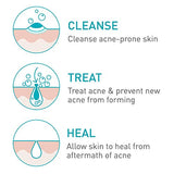 CeraVe Acne Foaming Cream Cleanser | Acne Treatment Face Wash with 4% Benzoyl Peroxide, Hyaluronic Acid, and Niacinamide | Cream to Foam Formula | 5 Oz